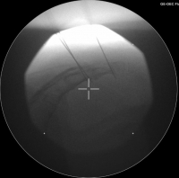 Röntgenbild sakrale Neuromodulation