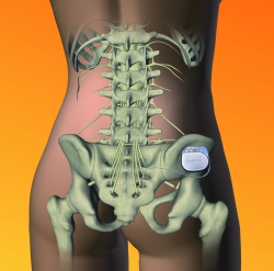 Sakralnervenstimulation