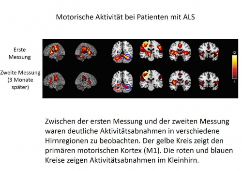 ALS-Studie