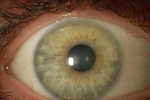 Auge 2