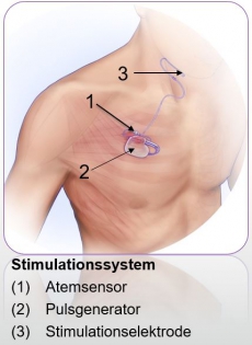 Zungenschrittmacher_Inspire Medical Systems Inc
