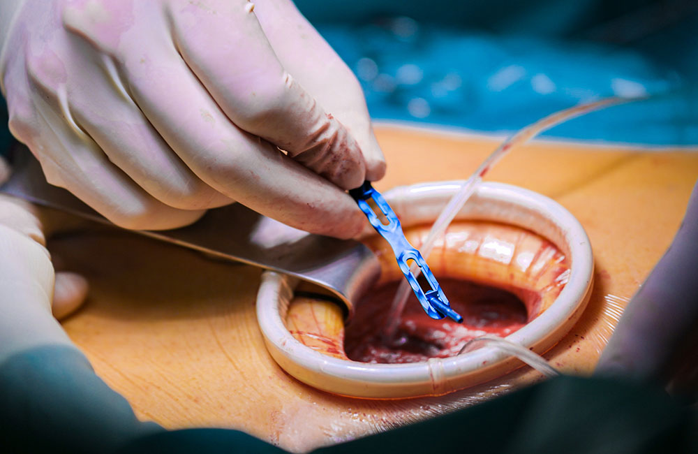 Implantatsystem RipFix