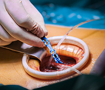 Implantatsystem RipFix