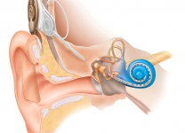 HNO-Cochelar Implant-Schema