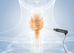 Thermoablation