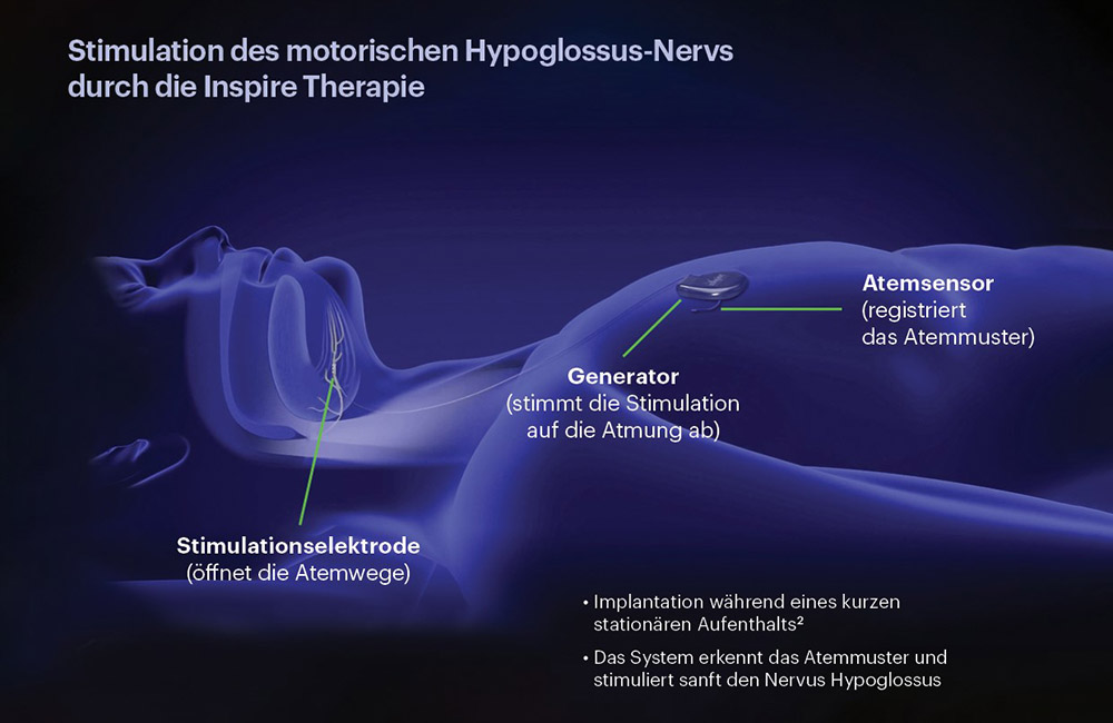 Zungenschrittmacher, Grafik: Inspire Medical Systems Inc.